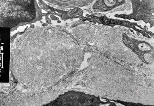 M,60y. | jejunum - amyloidosis